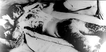 man-burned-2