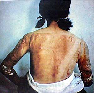 keloids-on-back